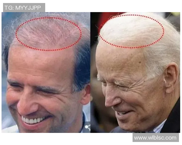 足球明星植发揭秘谁在为脱发烦恼重拾自信与风采 足球明星植发揭秘谁在为脱发烦恼重拾自信与风采